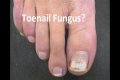 What does it mean when toenail fungus turns white?